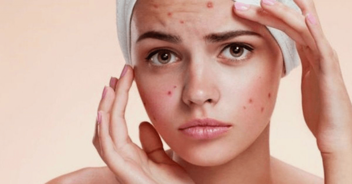 Chăm sóc da sau nặn mụn là một bước quan trọng