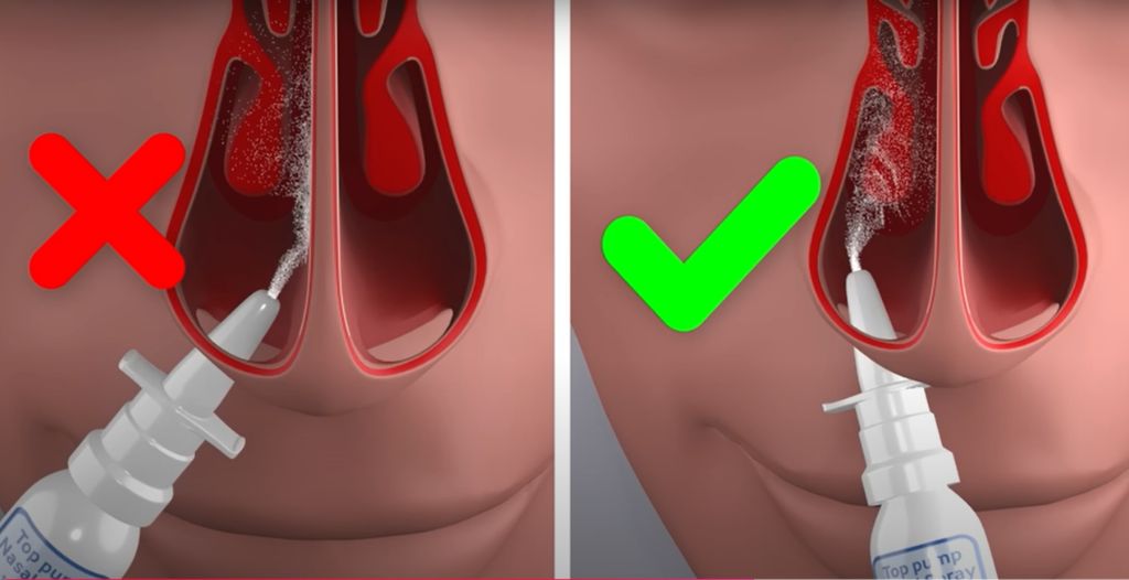 Cách đặt đầu xịt đúng cách (Nguồn ảnh: BMJ Learning)